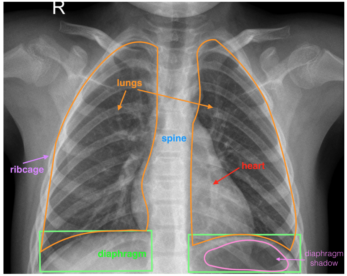 A labeled, healthy, chest x-ray image.