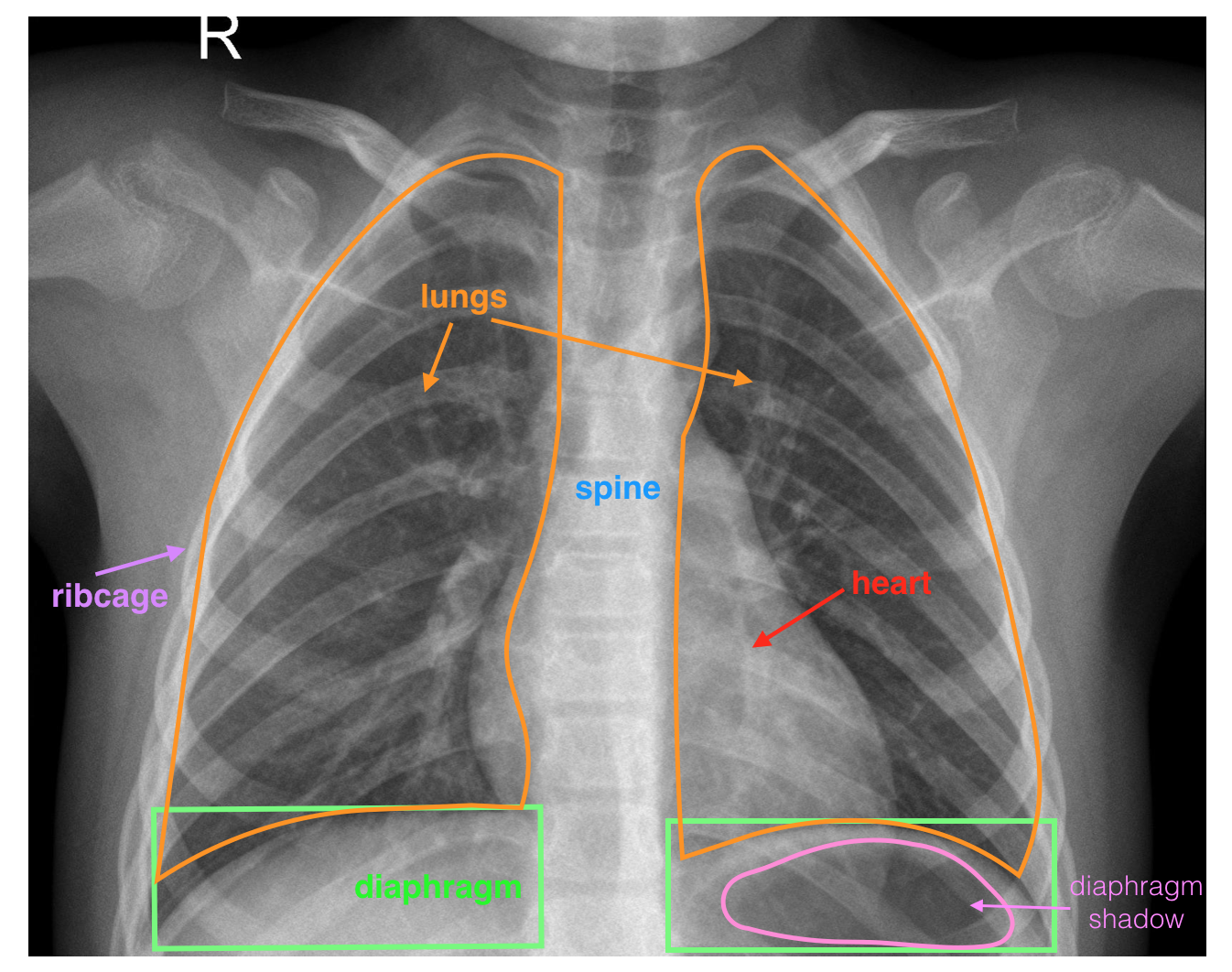 A labeled, healthy, chest x-ray image. Pay close attention to the two lungs and diaphragm (below the lungs).