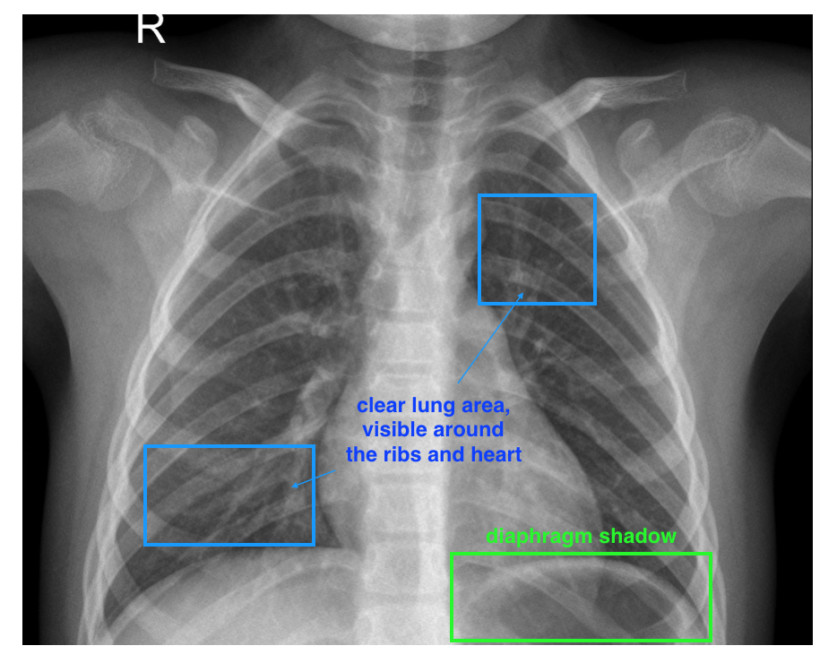 Some characteristics of a healthy image: a clear lung area.