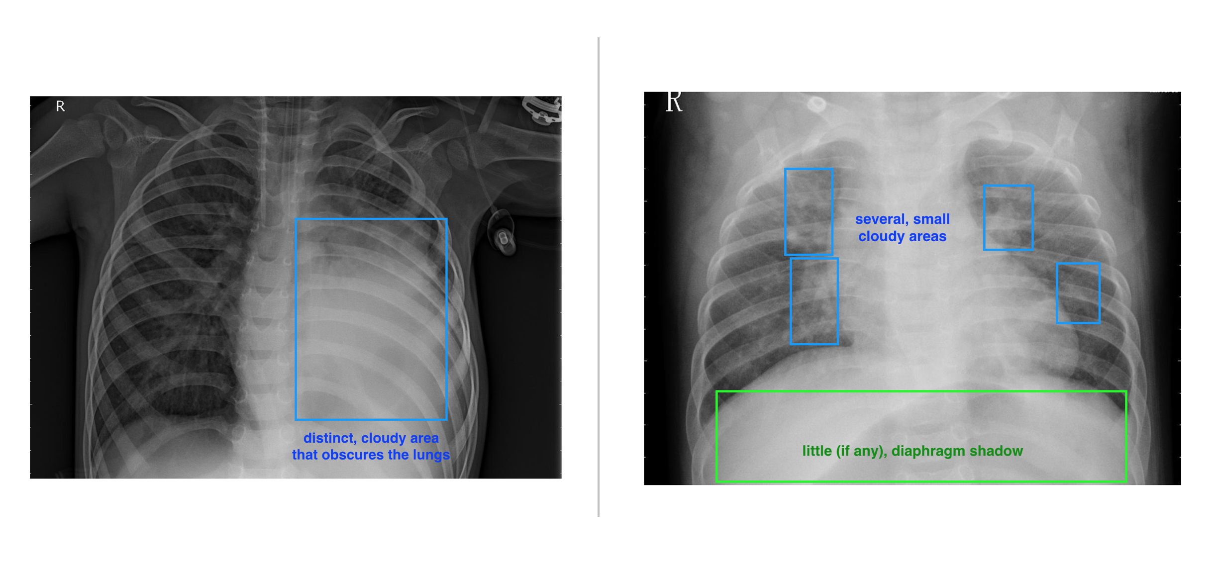 Examples of pneumonia symptoms: (Left) a concentrated, opaque area in the lungs, (Right) multiple, smaller opaque areas throughout the lung area and any diaphragm shadow is obscured.