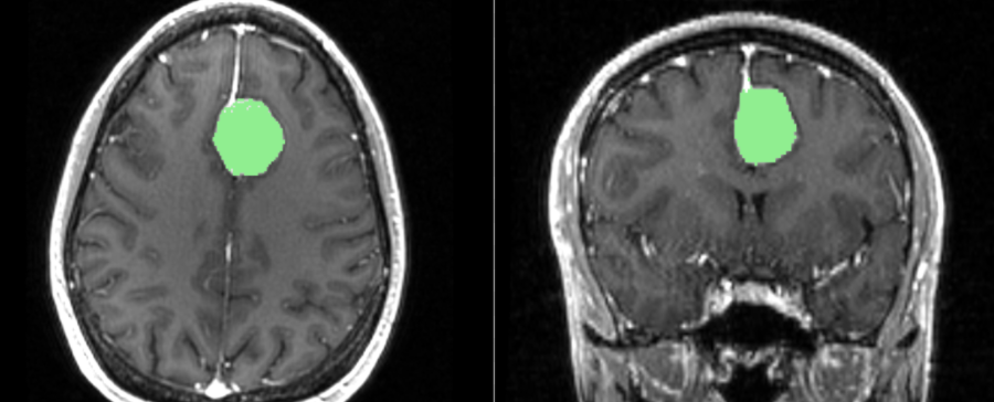 Brain MRI, in which a tumor is recognized and colorized in an image