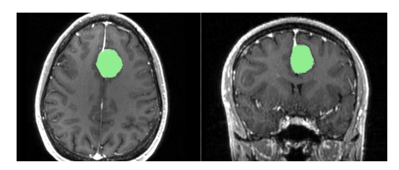 Brain MRI in which a tumor is recognized and colorized using computer vision.